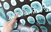 What Causes Multiple Sclerosis: Exploring Theories, Genetics, and Bad Habits