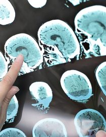 Exploring the Theories, Genetics, and Factors of What Causes MS Exploring the Theories, Genetics, and Factors of What Causes MS