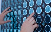 What Is MS?